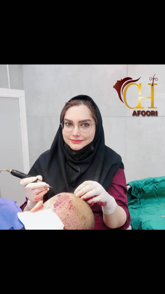 کاشت موی سر